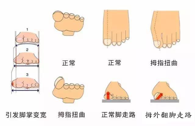 大脚骨疼痛怎么办牛江红科普 - 知乎