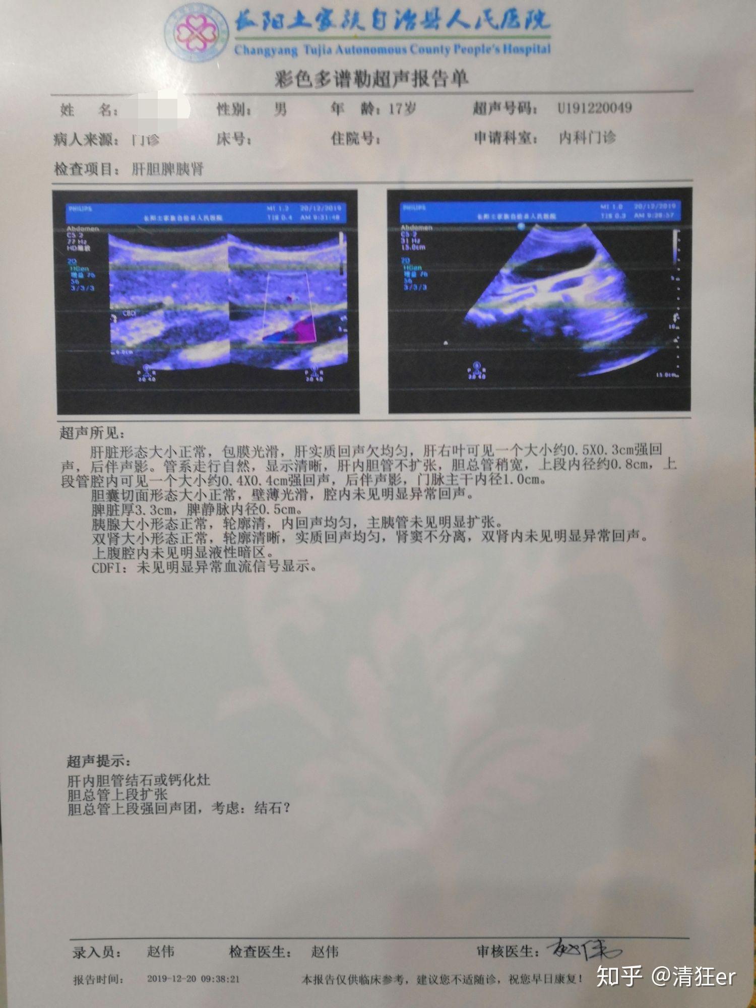 肝内胆管结石超声报告图片