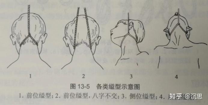 从胡鑫宇案来谈谈自缢与死后缢尸的鉴别 - 知乎