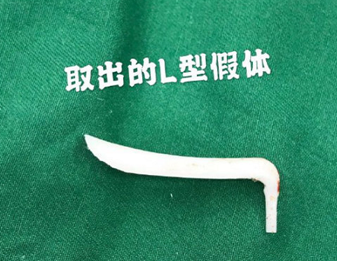 在隆鼻手术中选用的膨体材质真的比硅胶隆鼻更容易感染吗