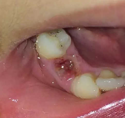 拔完智齿后令人闻风丧胆的干槽症是怎么回事