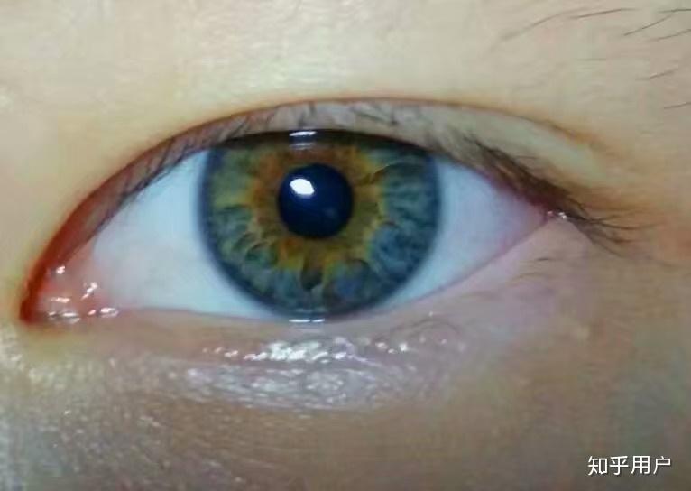 现实中人类异色瞳虹膜异色症的概率是多少
