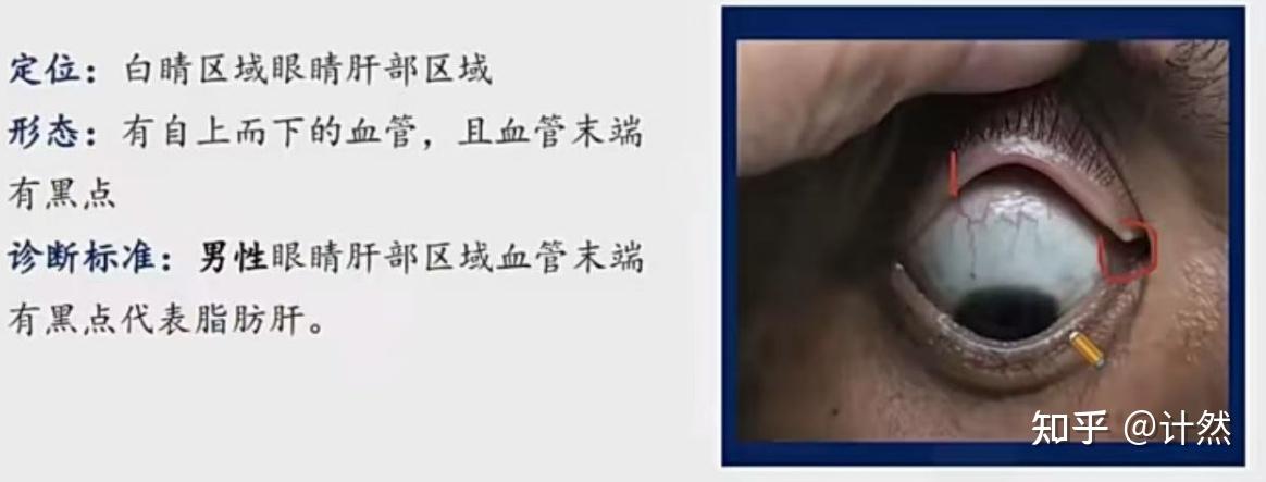 瑶医目诊 - 知乎