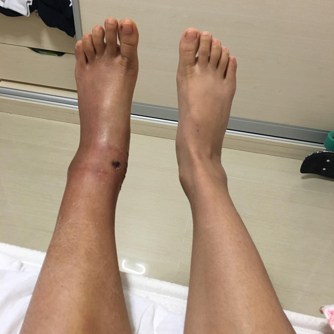 脚踝骨折怎么做才能恢复的快? - 知乎
