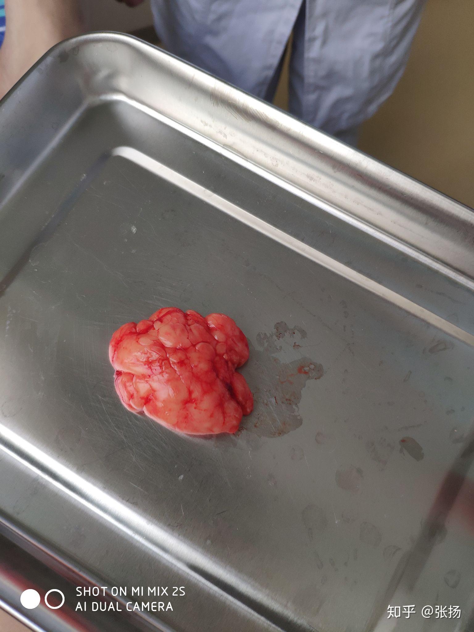 我是一名18岁的男生胳膊和大腿上都长有脂肪瘤请问脂肪瘤能不能治好