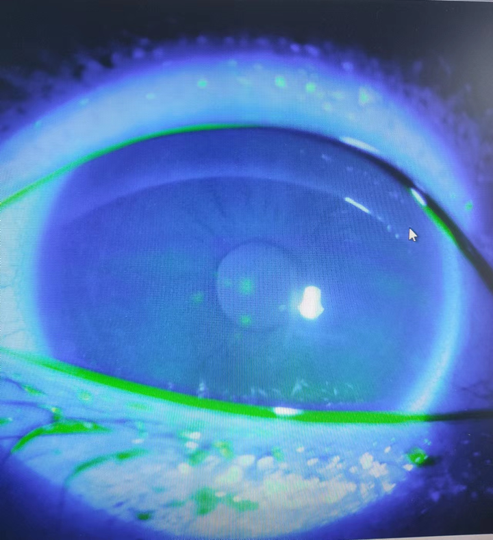 角膜浸润处理逻辑案例1例