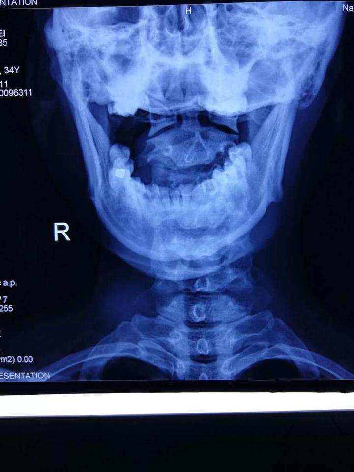 寰枢关节半脱位的影像学诊断