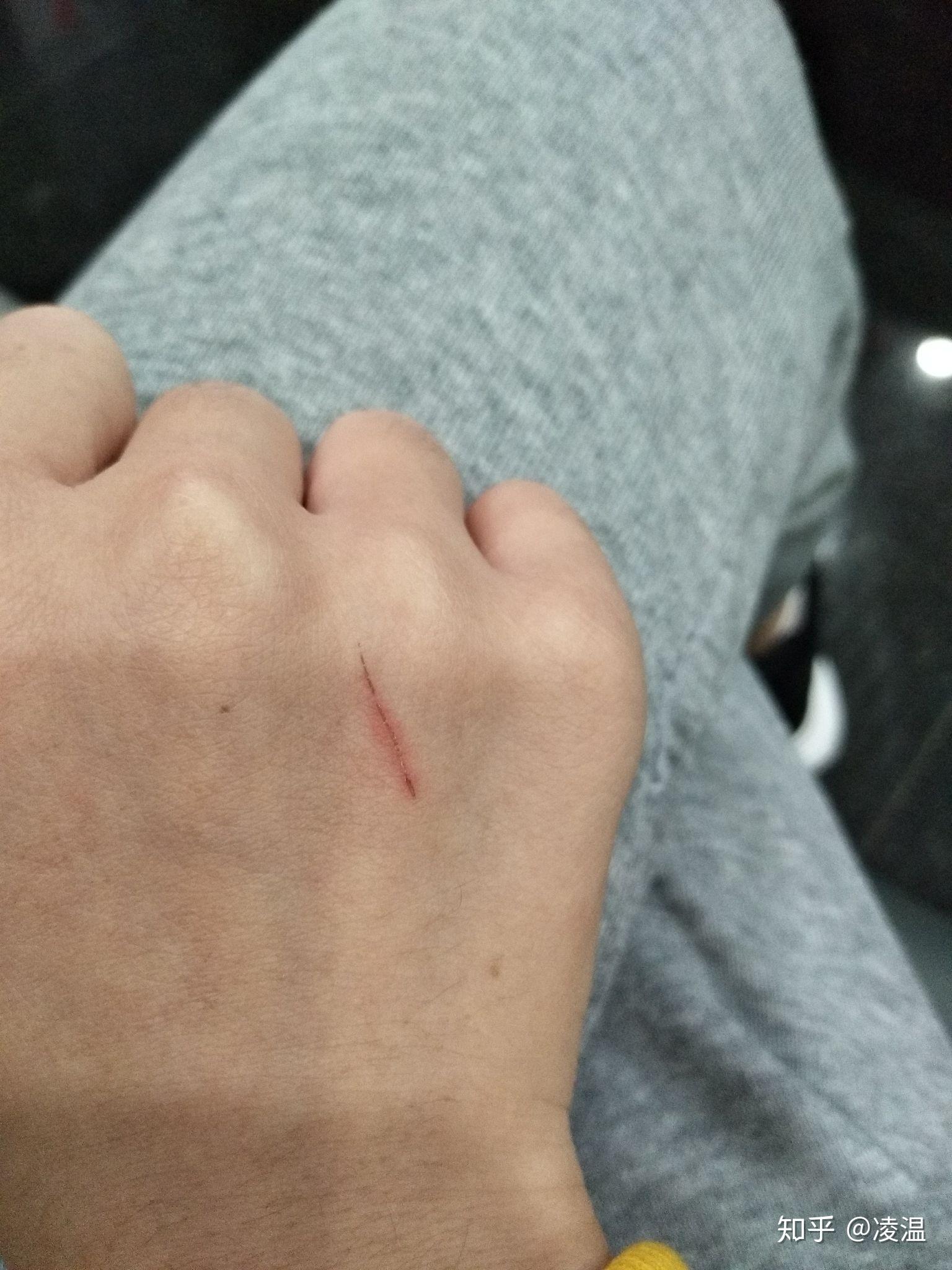 被猫抓破出血了会有事吗? - 知乎