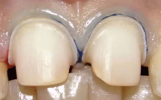 这颗牙冠这样做合理吗?