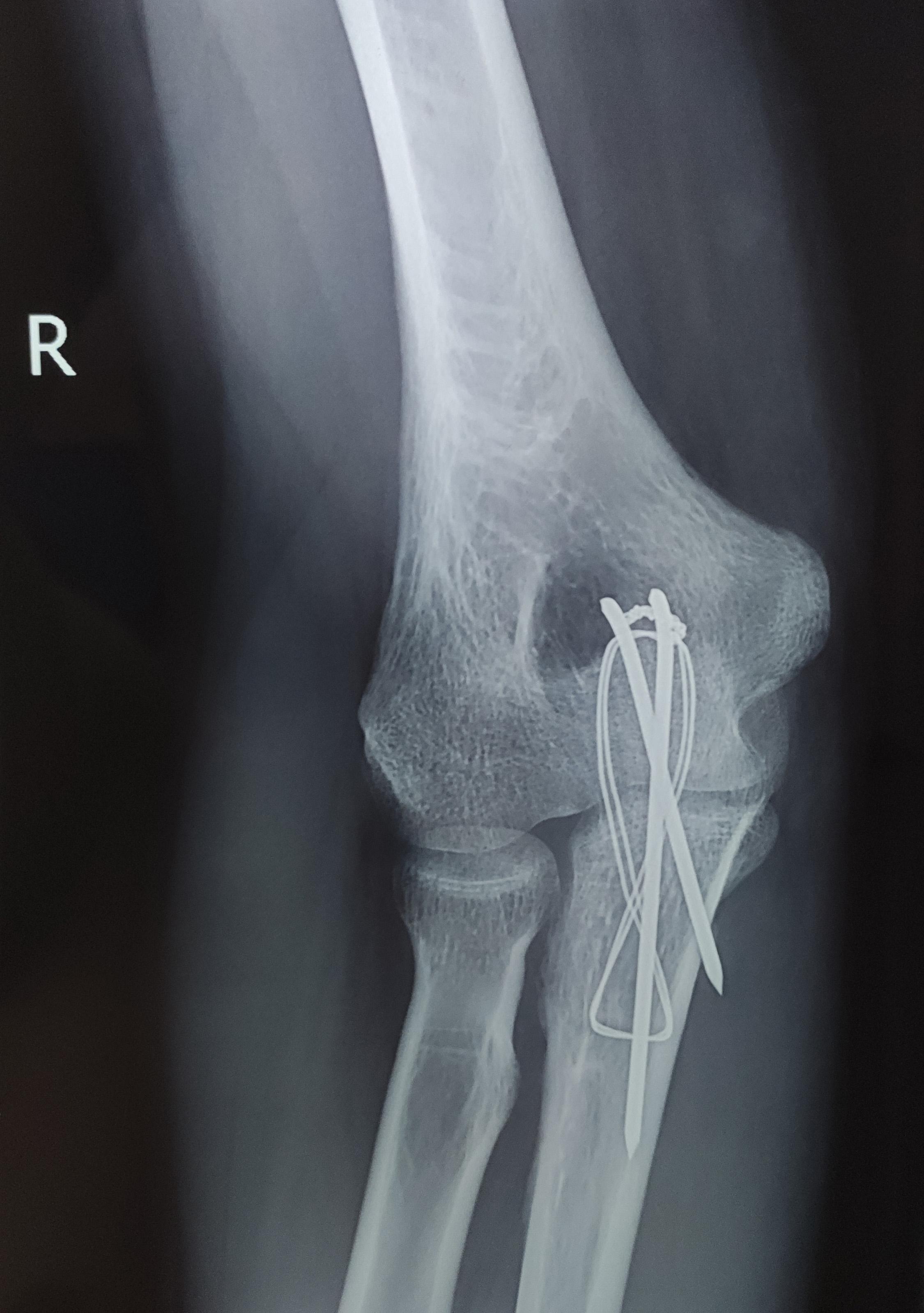 应用解剖型锁定钢板内固定治疗尺骨鹰嘴骨折的病例对照研究_参考网
