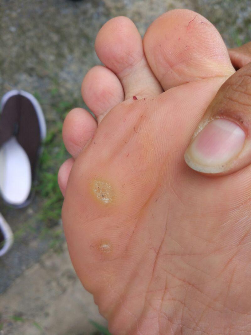 脚上的茧子怎么去掉