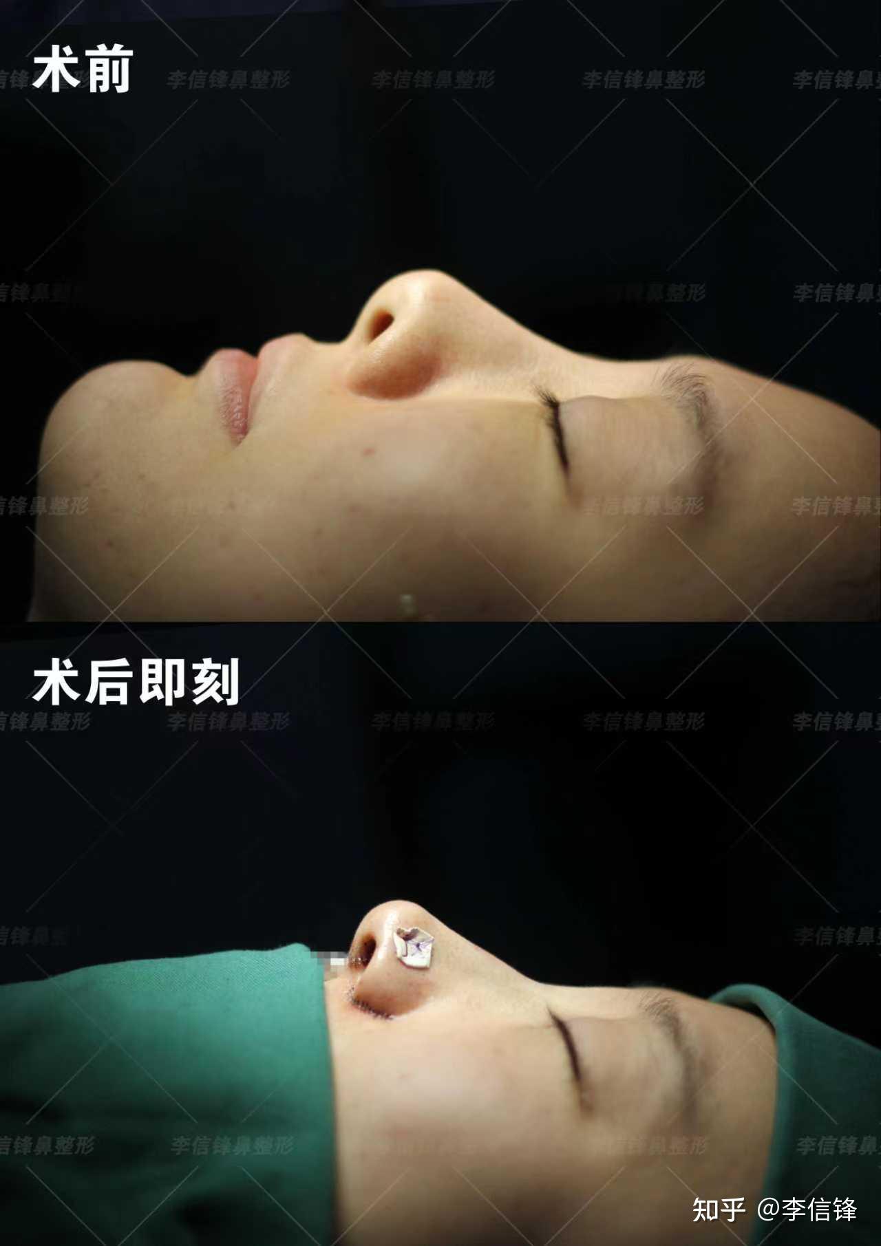 多年前隆鼻挛缩成朝天鼻,鼻修复术后即刻,漏鼻孔改善太明显 - 知乎