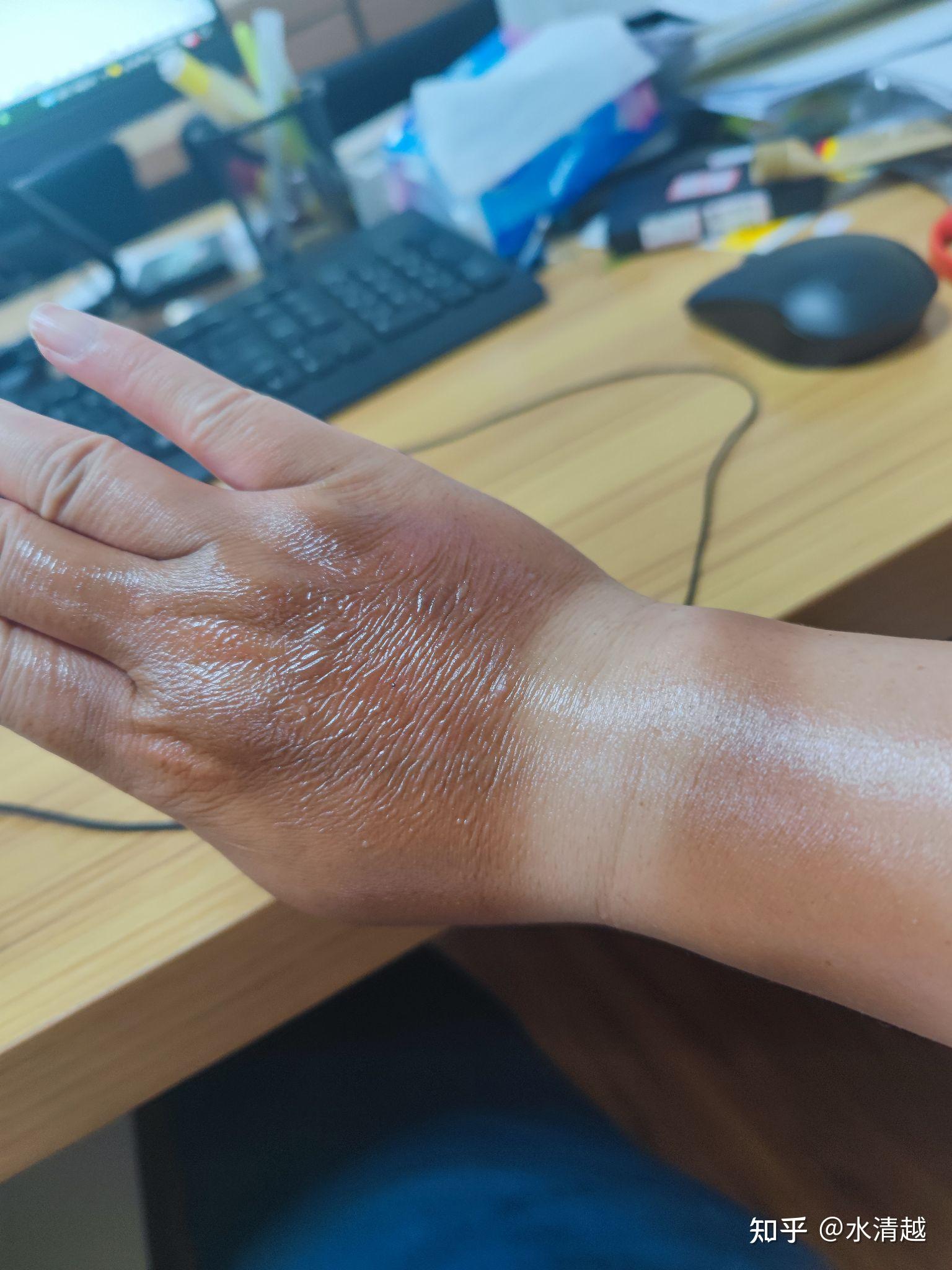 晒伤了啥症状我这样算晒伤吗