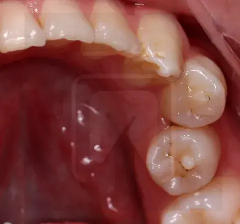 怎么处理畸形中央尖