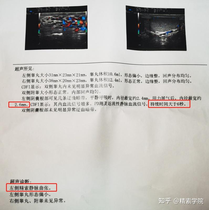 阴囊彩超为什么没有提到精索情况? - 知乎