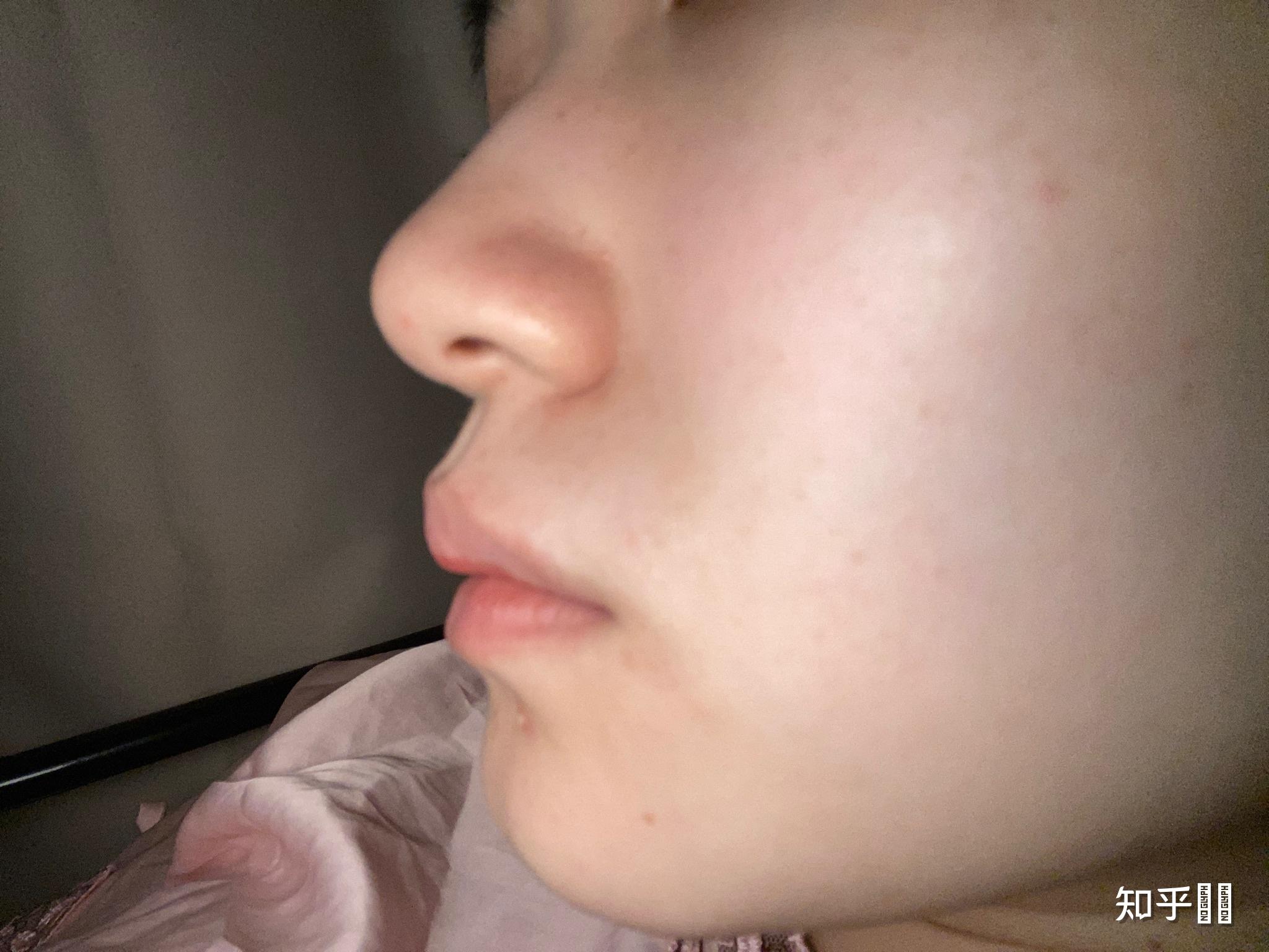 我到底是凸嘴还是人中肉厚