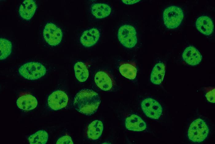 抗核抗体(ana)阳性的临床意义