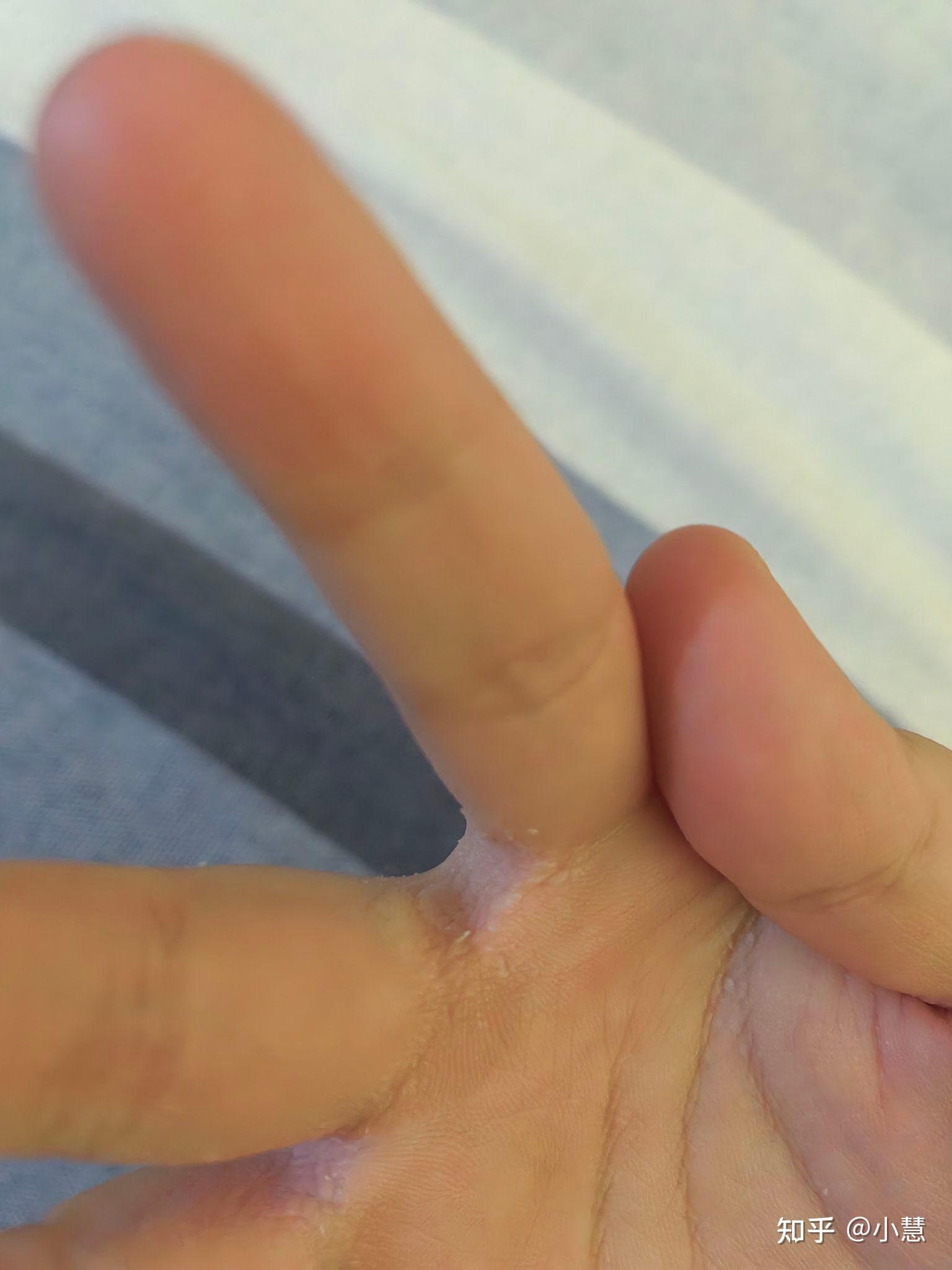 手指缝遇水起起皱脱皮?