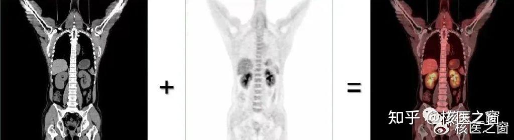 pet-ct是增强ct吗？pet-ct检查什么？ - 知乎