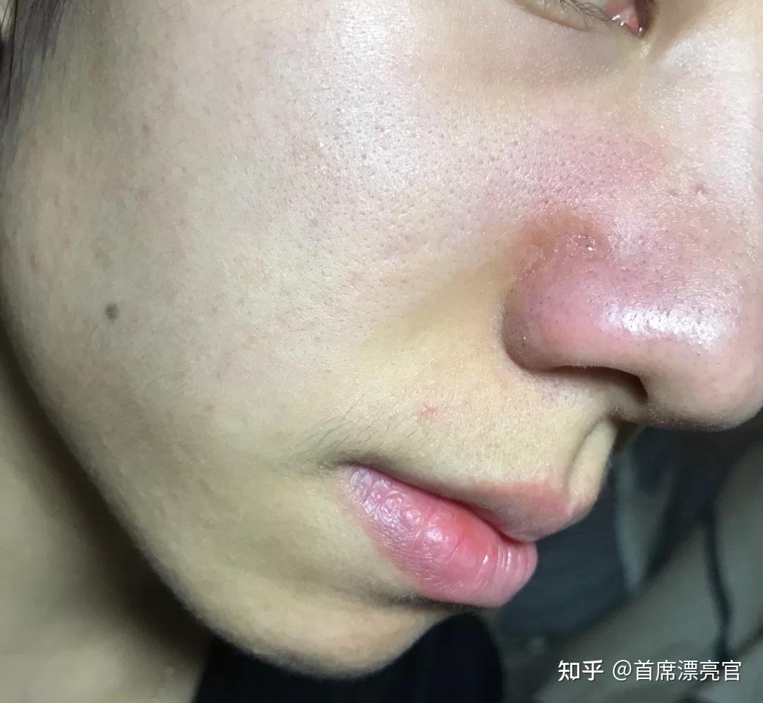 细胞夹效果好吗,可以夹出黑头吗? - 知乎