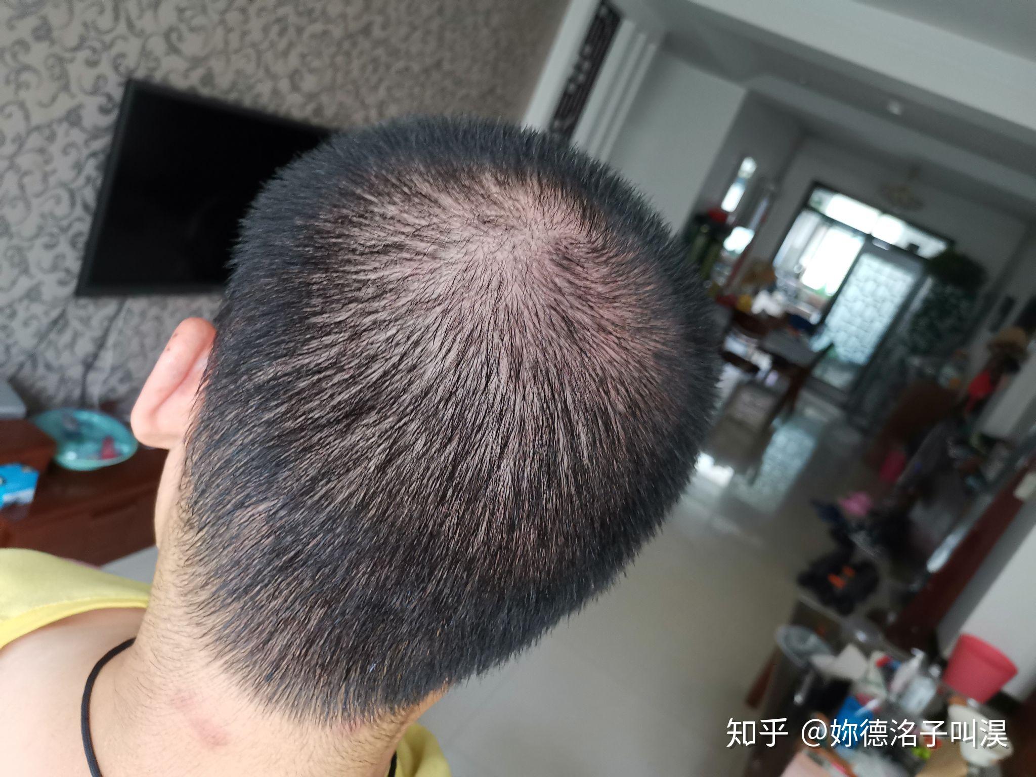 男人头发稀少(男人头发稀少是什么原因造成的)