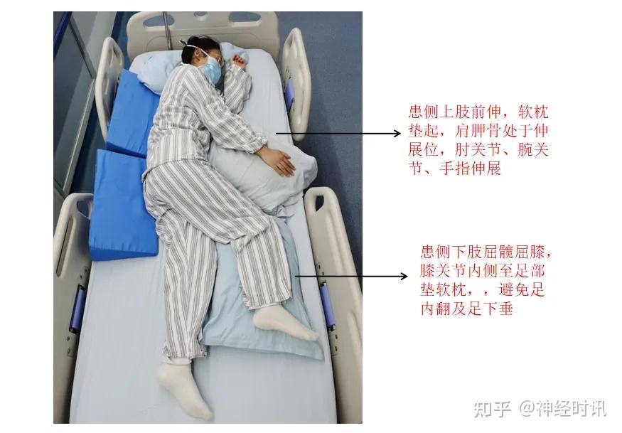 脑卒中患者康复——肢体摆放多图详解 - 知乎