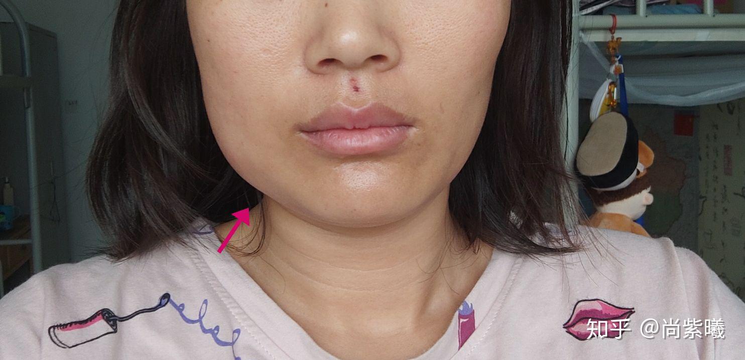 拔智齿脸都要肿成这样么