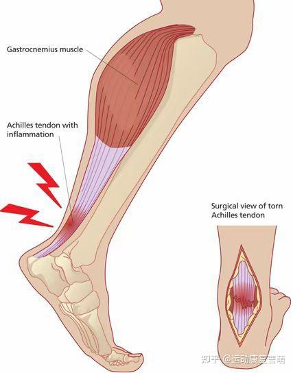 跟腱断裂感受图片