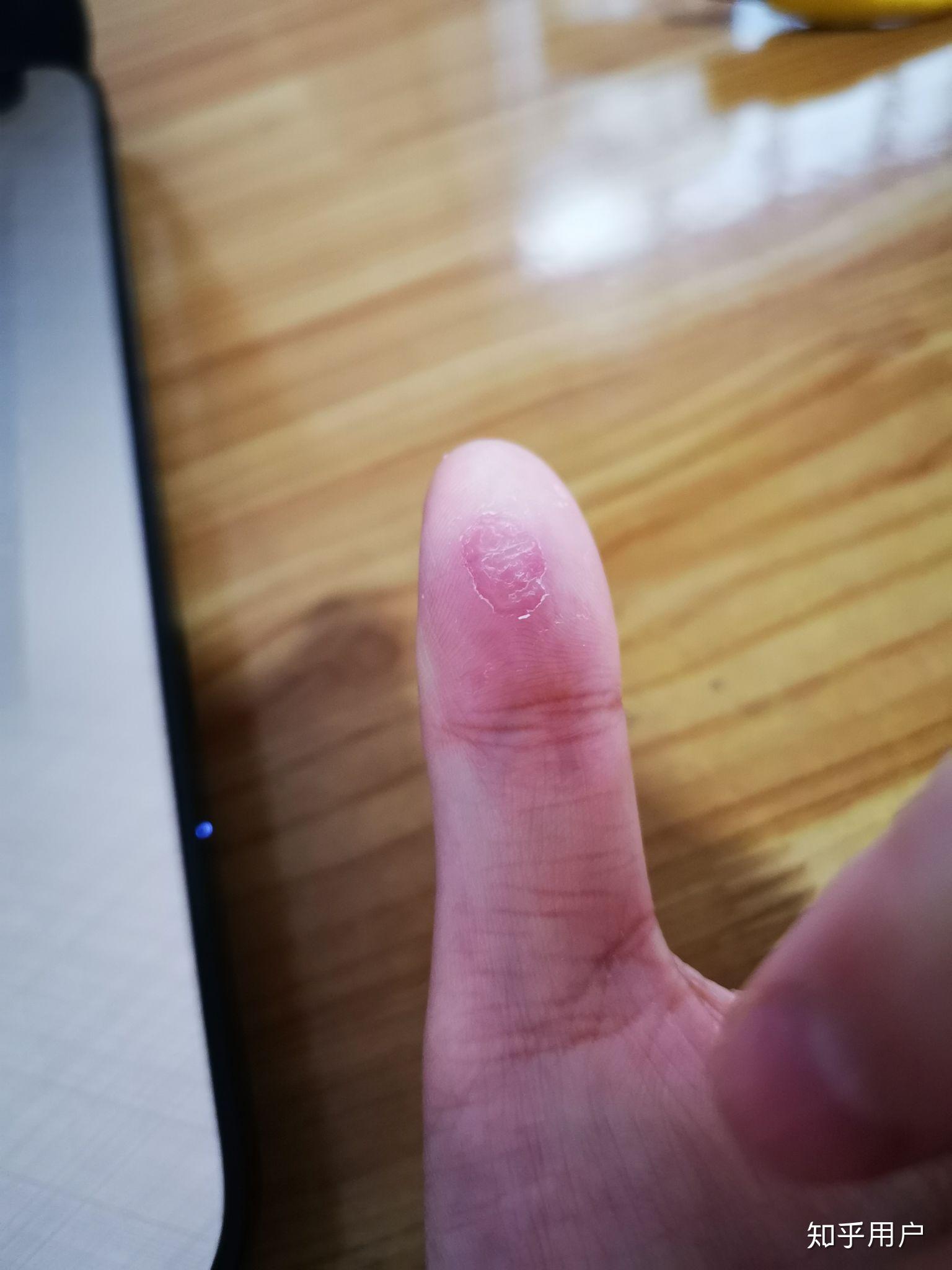 手指尖脱皮与气候季节的相关性是怎么形成的