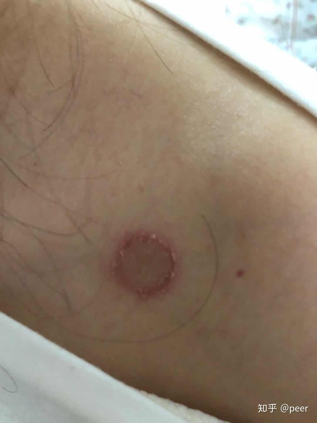 人得了猫癣怎么治疗啊急