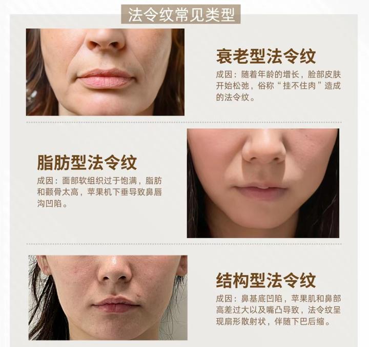 怎样改善法令纹? - 知乎