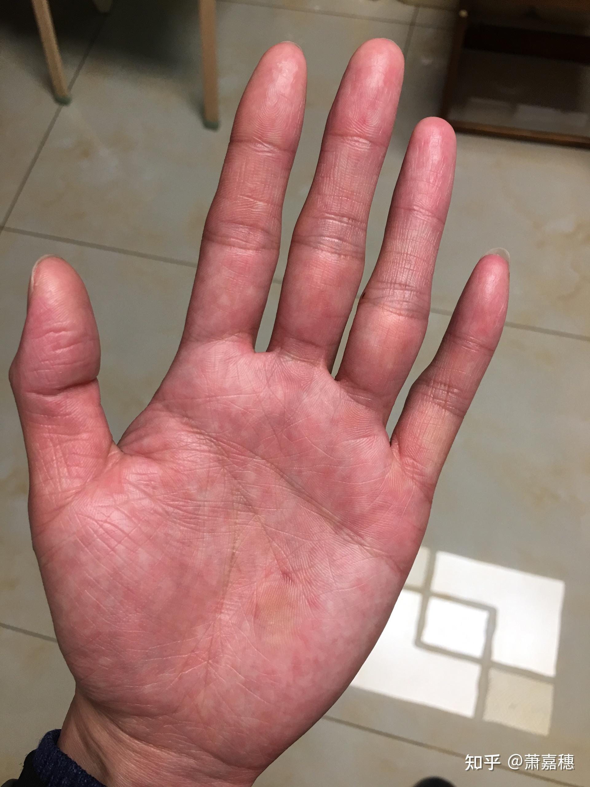 一到秋天转冬天的时候手掌就呈现红色的斑块会痒摸起来也比较硬手指会