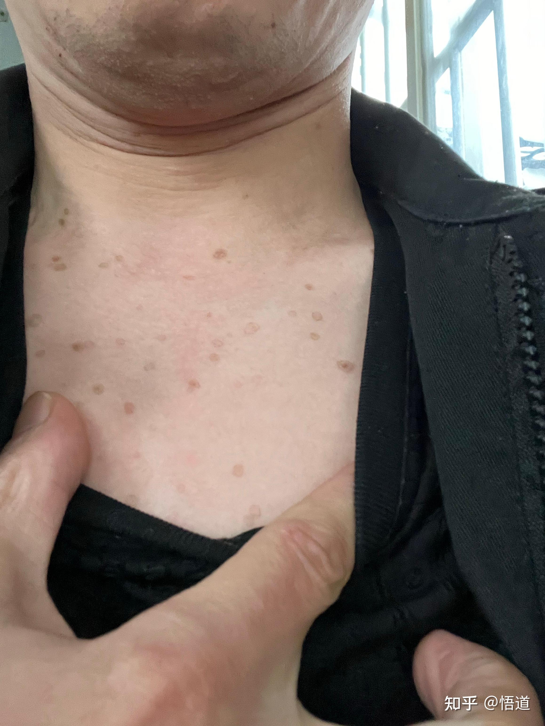 这种斑如何消除,我30多点就开始有,现在40了越来越多?
