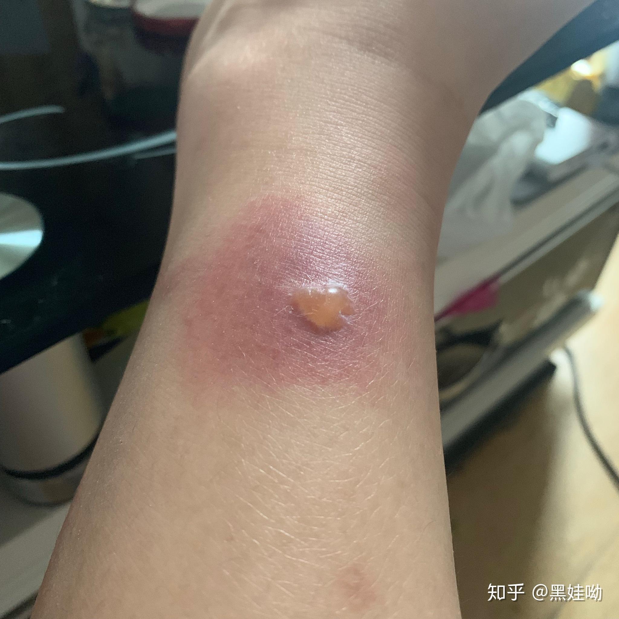 被蚊子咬的包第二天都肿的特别大怎办? - 知乎