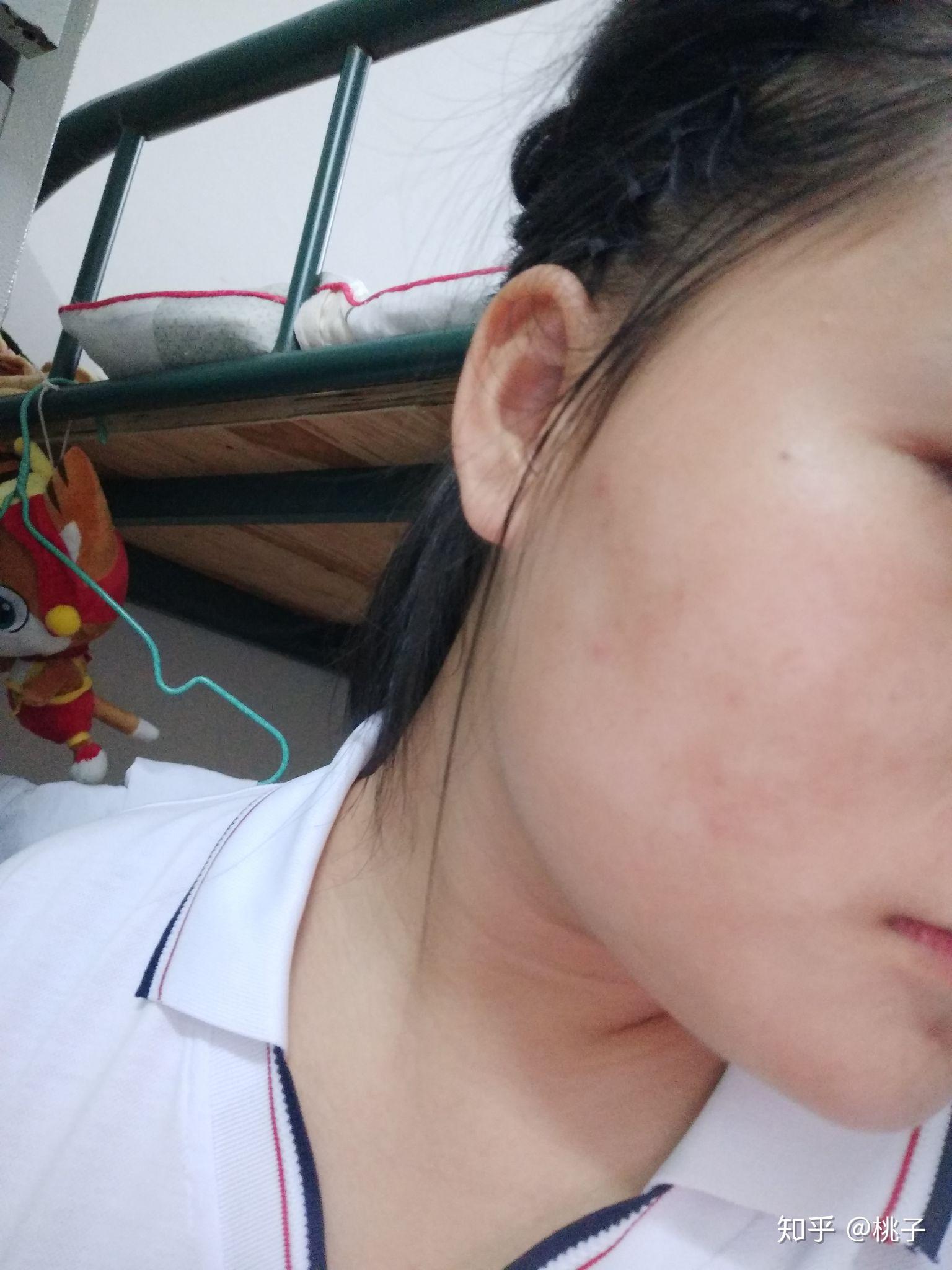 我一个女生脸上长花斑癣可怎么办阿? - 知乎