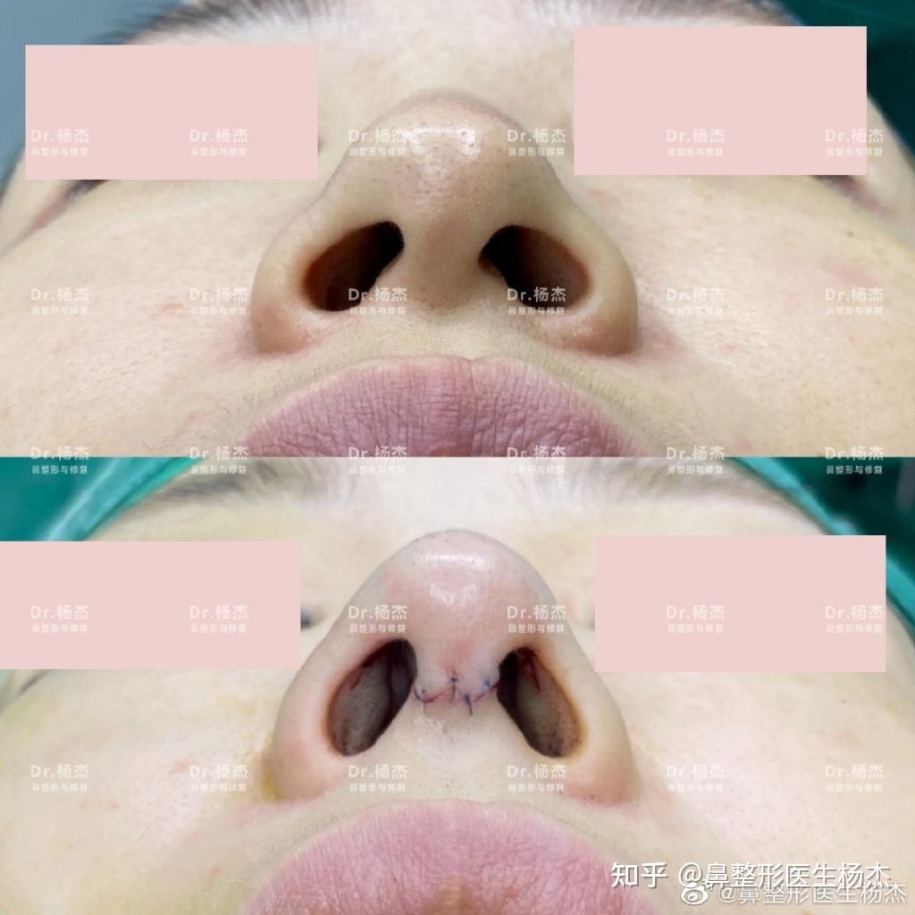 驼峰鼻的诊断与治疗 - 知乎