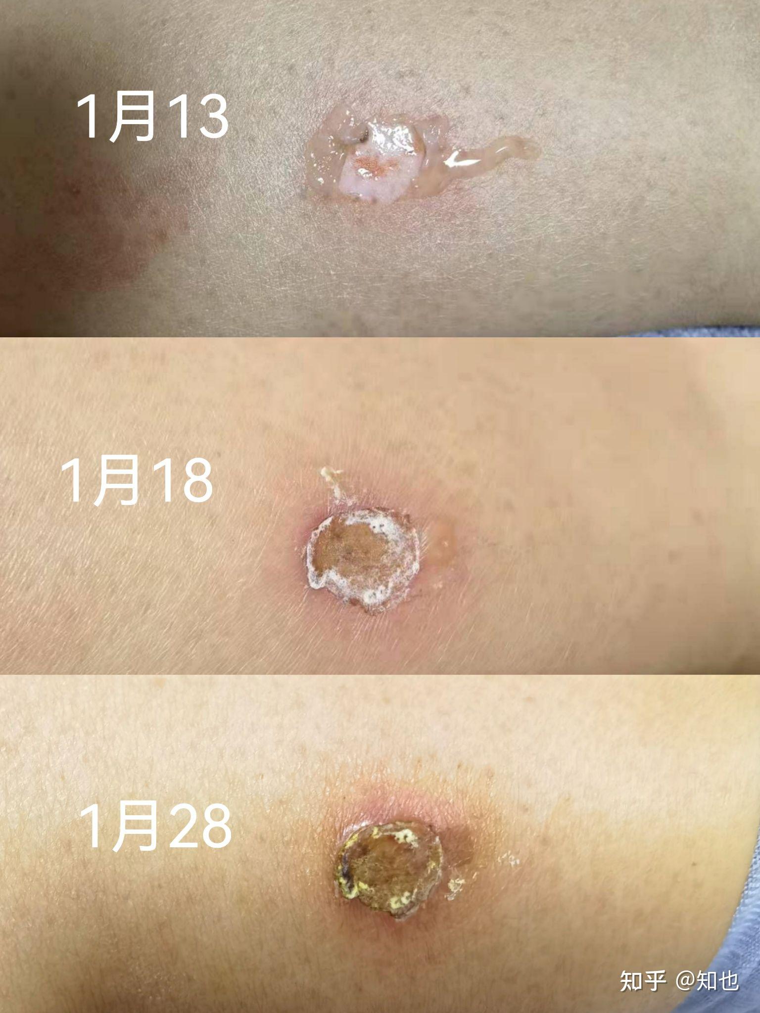 低溫燙傷後請問疤越結越厚要怎麼處理