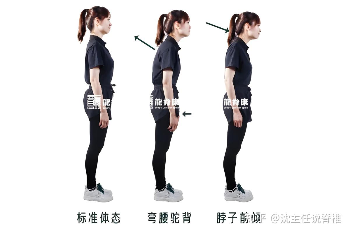 腰椎生理曲度变直的危害有多大?可以恢复吗? - 知乎