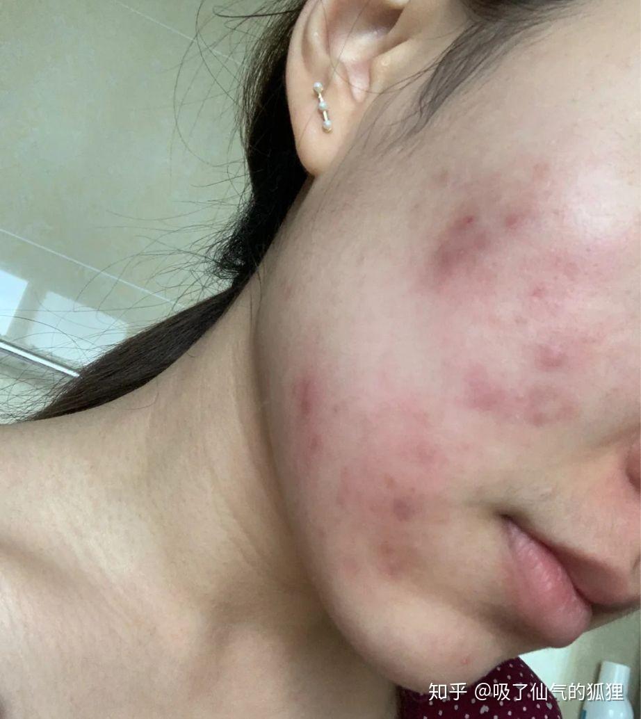 为什么会浮粉怎么解决啊