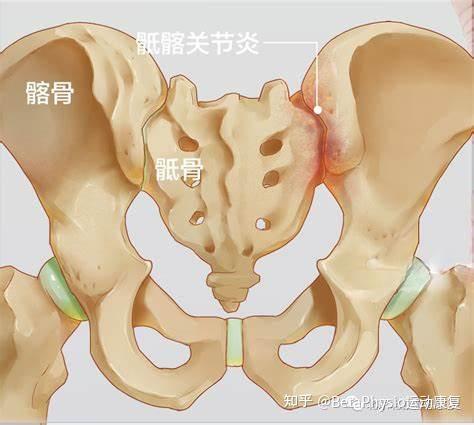 致密性骶骨关节炎