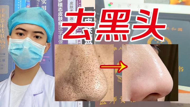 【男生去黑头必看】男生怎么做才能把脸上的黑头“连根拔起”？还不反复！【皮肤科医生】教你4步男生去黑头的方法，将黑头一扫而光！ - 知乎