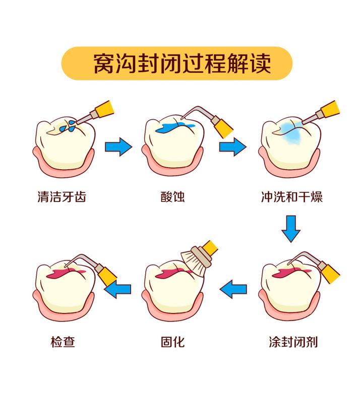 窝沟封闭步骤图图片