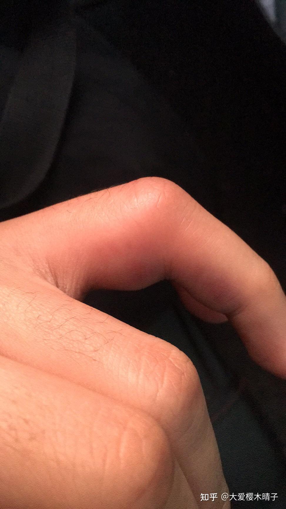 打篮球手指脱臼处理? - 知乎