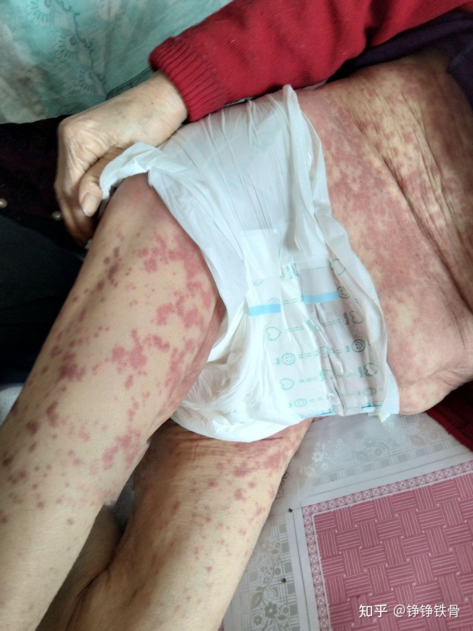 我爸的身上长了大片的红斑他又不肯去医院不知道这是什么病症在线等急