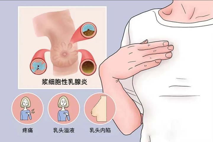 乳腺瘘管图片