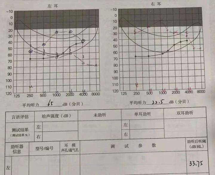 案例分享|单耳听力下降,差耳每天听训,真的有用吗? - 知乎