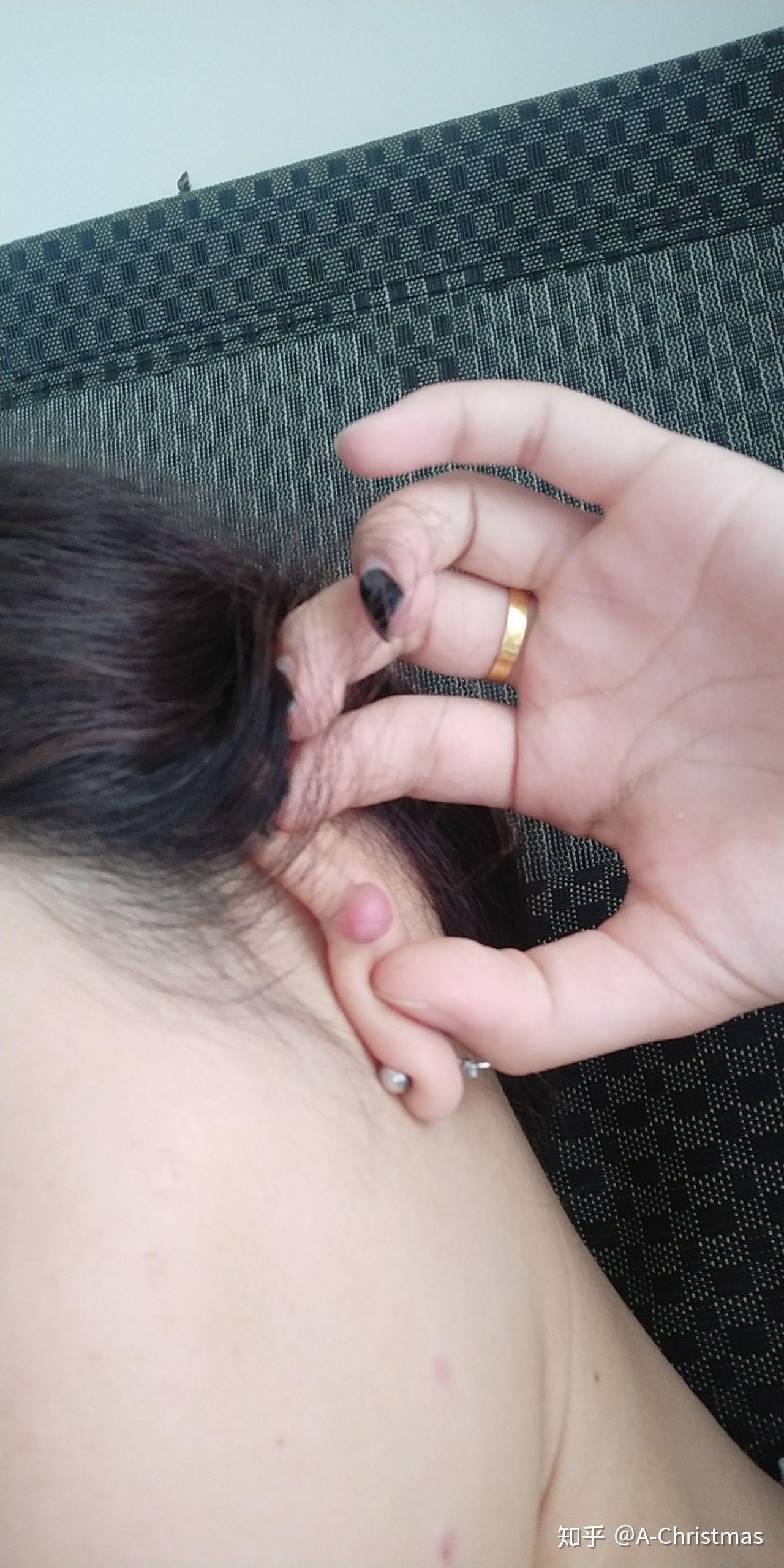 耳洞疤痕疙瘩初期图片