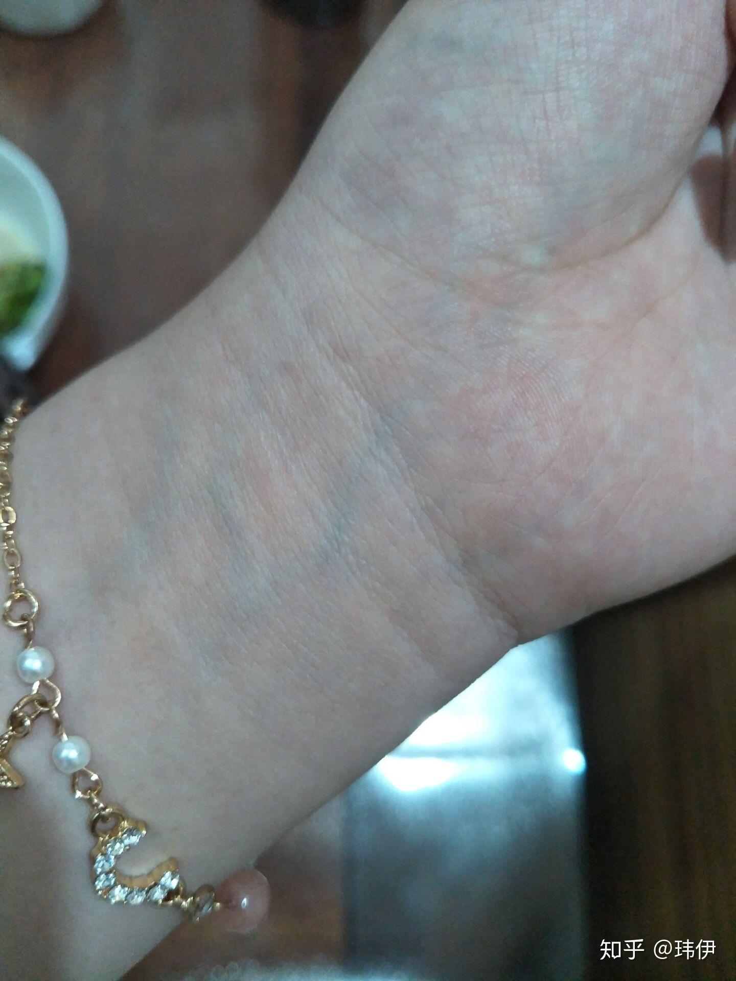 手腕上静脉颜色很明显是身体有什么病症的原因吗