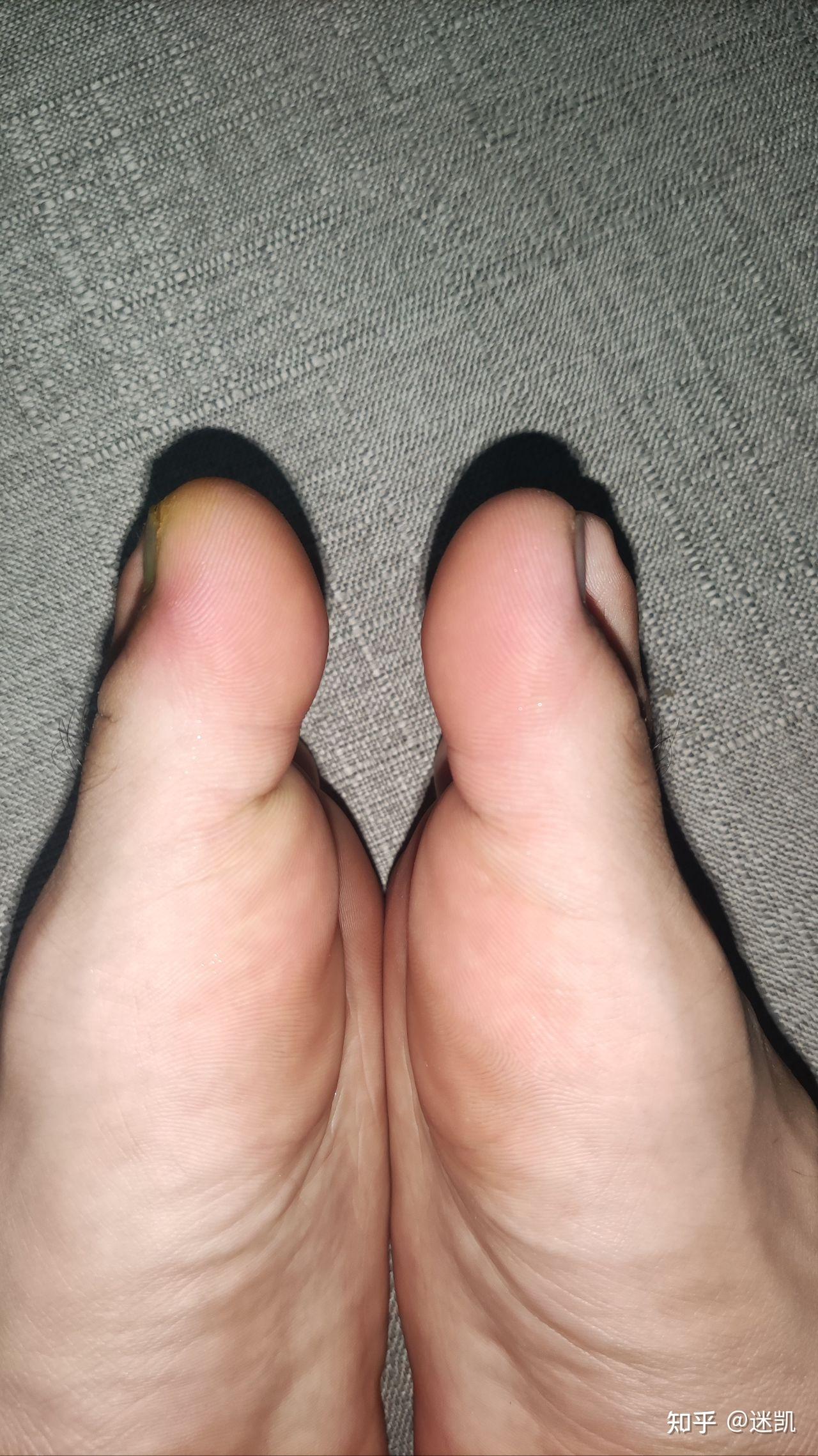 左脚大拇指被重物砸了 指甲内有淤血 特别疼 已经疼了一个晚上了 请问