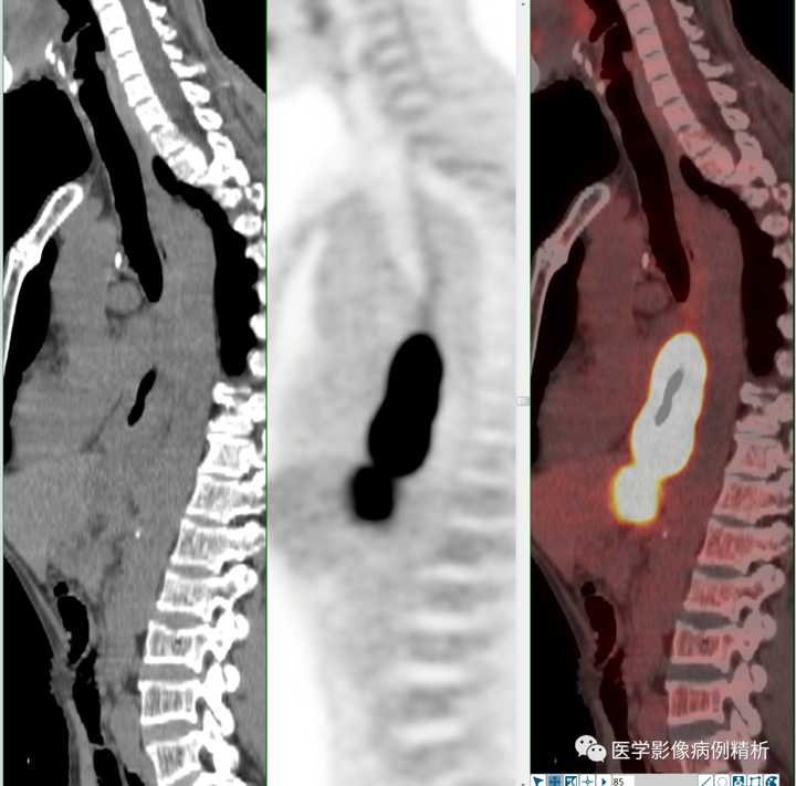 一文通读解析PET-CT检查所有注意事项、放射性危害及典型教学病例一例 - 知乎